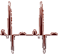 EKG graph